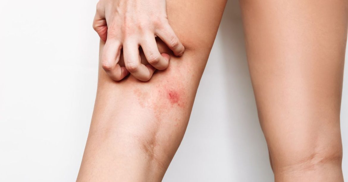 2_A-young-woman-scratching-an-insect-bite-on-thigh-A-red-rash-caused-by-allergy-inflammatory-process.jpeg